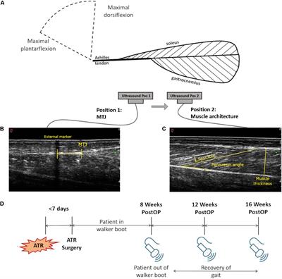 Muscle Fascicles Exhibit Limited Passive Elongation Throughout the Rehabilitation of Achilles Tendon Rupture After Percutaneous Repair